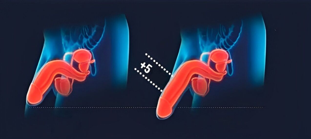 Penisvergrößerungsergebnisse mit Hyaluronsäure