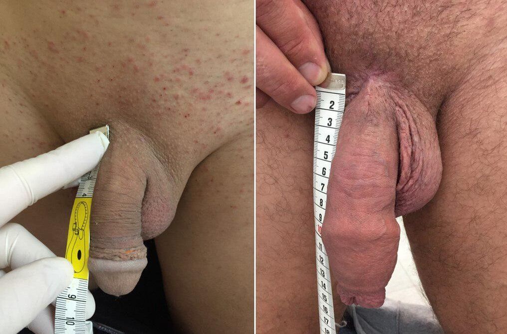 vor und nach der operativen Penisvergrößerung