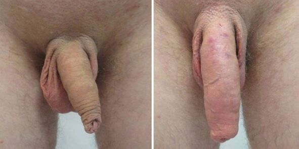 Penis vor und nach dem Aufhängen von Gewichten